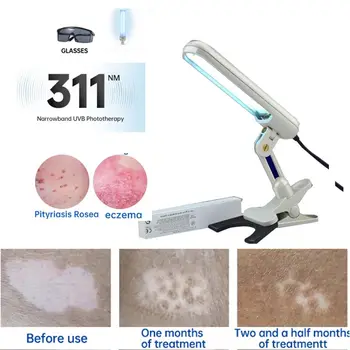 Устройство Лампа за Фототерапия UVB 311NM за Лечение на Витилиго UV-Узкополосная Терапия с Ултравиолетова Светлина Петна, Псориазис, Екзема